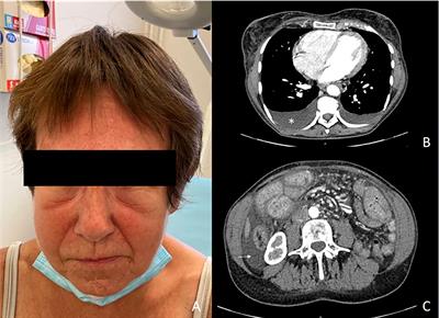 Nivolumab-induced capillary leak syndrome associated with chylothorax in a melanoma patient: A case report and review of the literature